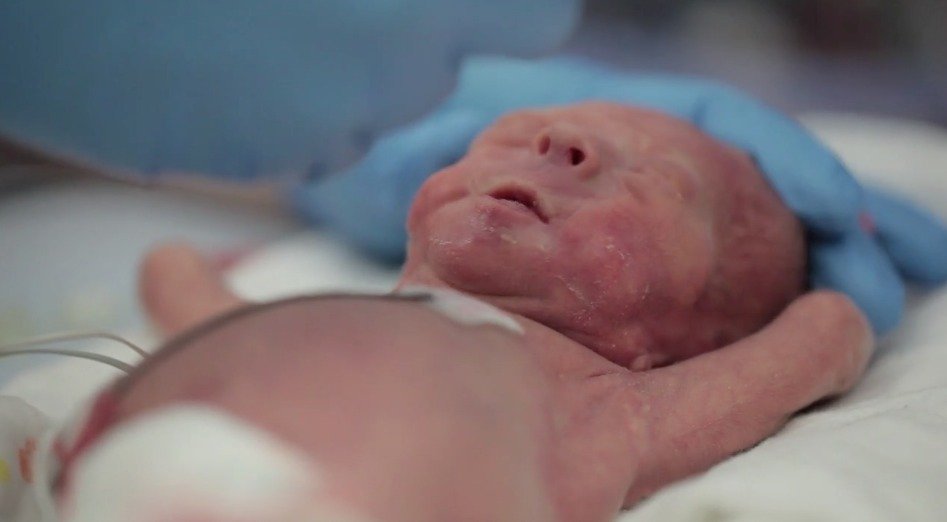 Медсотрудники назвали неустранимые последствия ранних родов