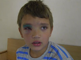 Бойцовская собака покалечила 10-летнего Малика